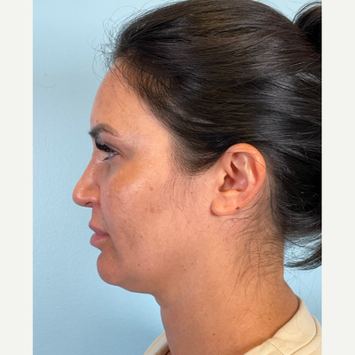 Buccal Fat Removal before 13079171 5924970