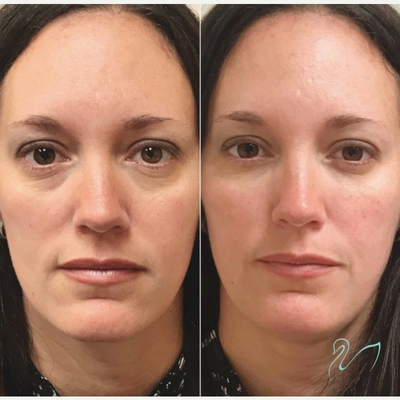 Dermal Fillers before and after photo