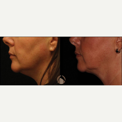 Kybella before and after photo