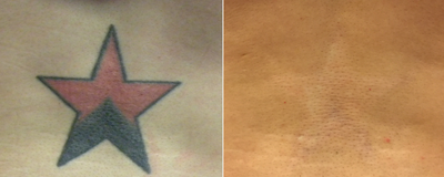 Tattoo Removal before and after photo
