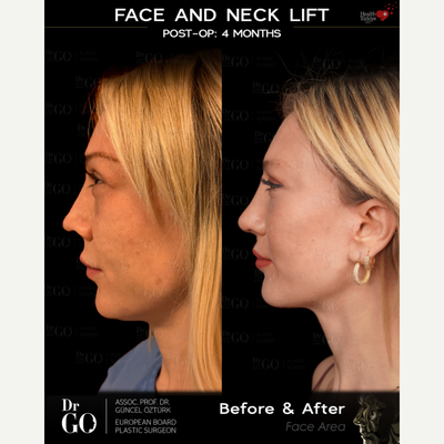 Facelift before and after photo
