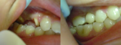 Tooth Repair before and after photo
