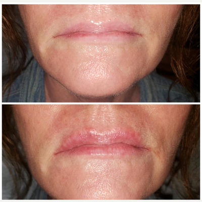 Restylane Kysse before and after photo