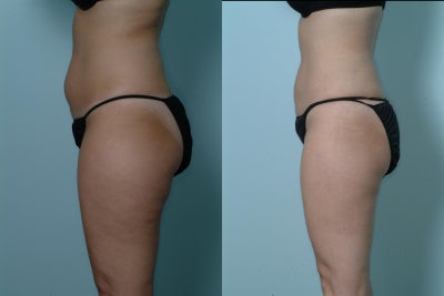 Liposculpture before and after photo