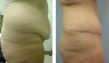 Tummy Tuck before and after photo