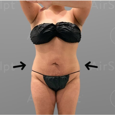 AirSculpt - Our Up a Cup™ procedure uses your own natural tissue