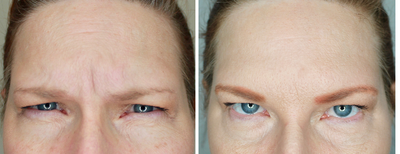 Dysport before and after photo