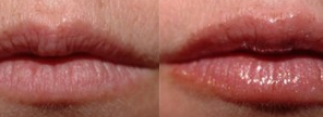 Lip Fillers before and after photo
