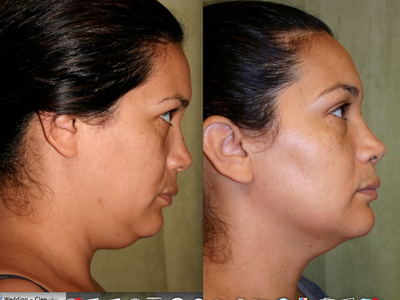 Liposculpture before and after photo