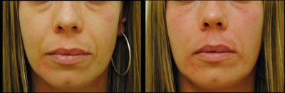 Restylane Lyft before and after photo
