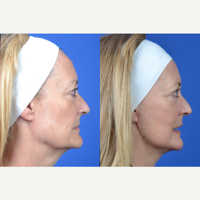 Facelift before and after photo