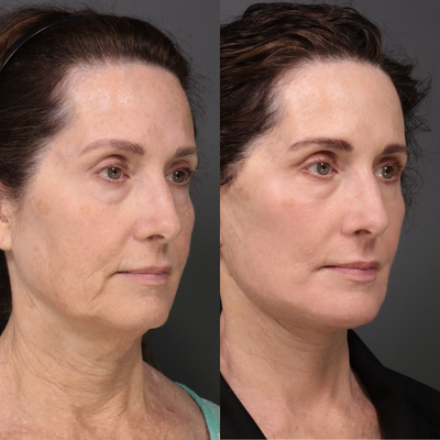 Buccal Fat Removal before and after photo
