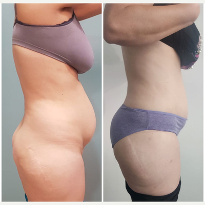 Liposuction before and after photo