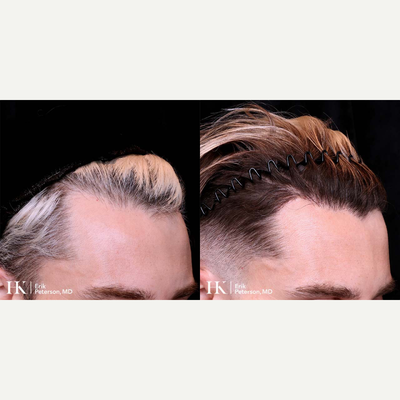 Hair Loss Treatment before and after photo