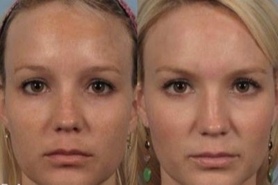 Fractional Laser before and after photo