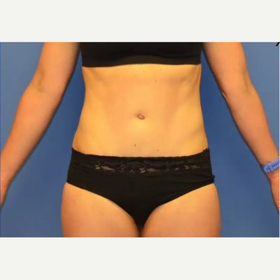 10 Things I Wish I Knew Before My Tummy Tuck