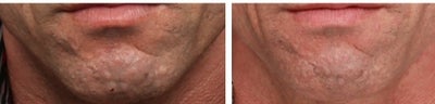 Fraxel Laser before and after photo