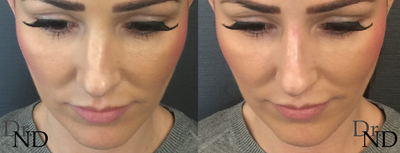 Nonsurgical Nose Job before and after photo