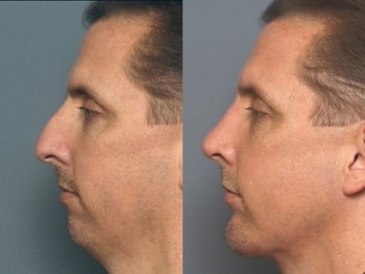 Chin Implant before and after photo