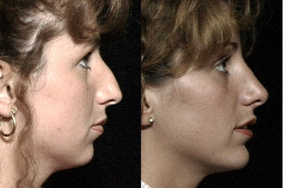 Rhinoplasty before and after photo