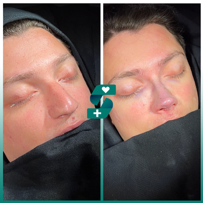 Rhinoplasty before and after photo