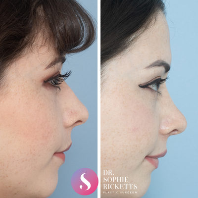 Rhinoplasty before and after photo