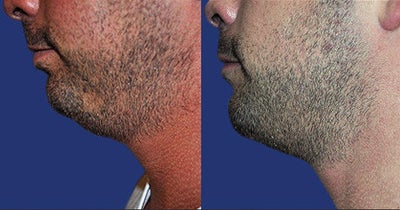Liposculpture before and after photo