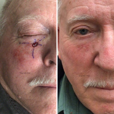 Mohs Surgery before and after photo