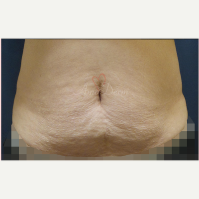 CoolSculpting Addison  FDA Cleared, Effective, Non-Surgical Fat Removal