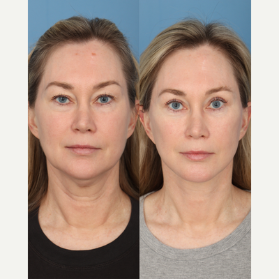Brow Lift before and after photo