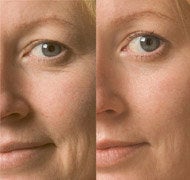 Facial before and after photo