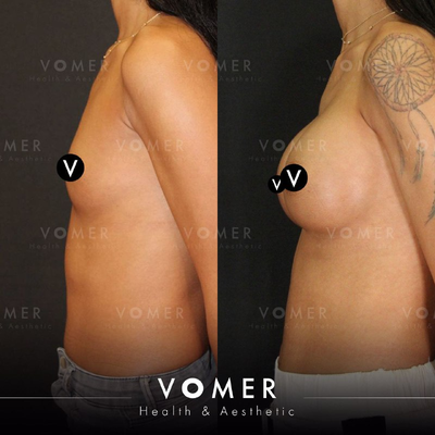 Breast Augmentation before and after photo