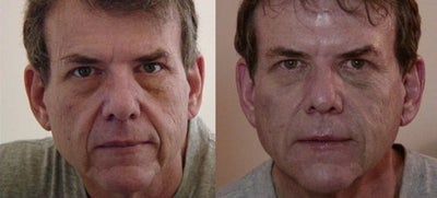 Dermal Fillers before and after photo