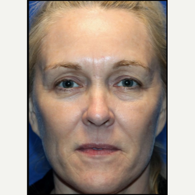 Skin Tightening Before & After - Charlotte Huntersville, NC: Saluja  Cosmetic and Laser Center
