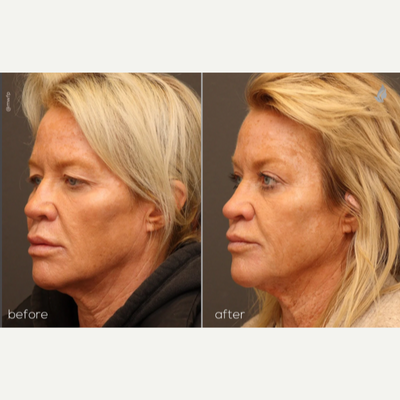 Brow Lift before and after photo