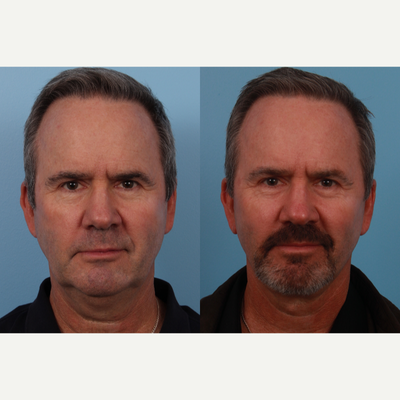Facelift before and after photo