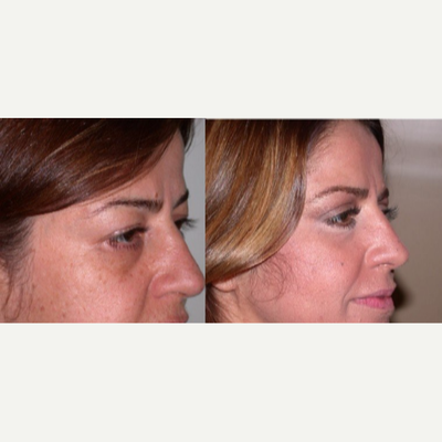 Eyelid Surgery before and after photo