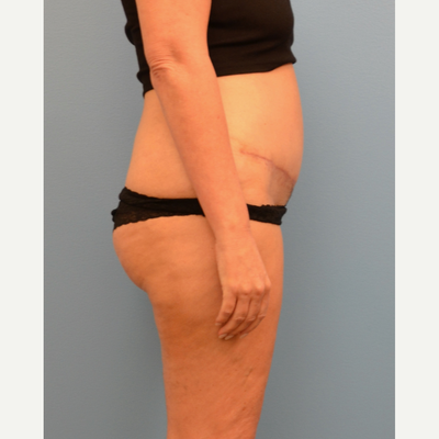 Liposuction - Abdomen / Flanks Before and After Pictures Case 14, Coeur  d'Alene, ID