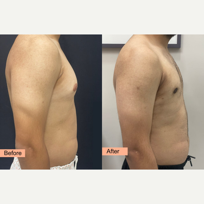 Gynecomastia Surgery before and after photo