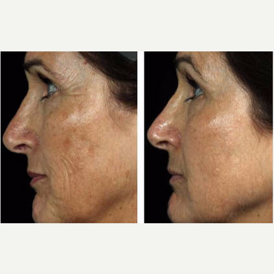 Fraxel Laser before and after photo
