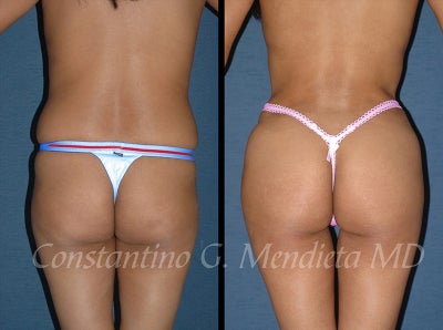 Butt Augmentation before and after photo