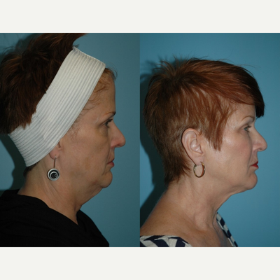 Kybella before and after photo