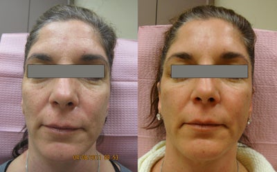 Fractional Laser before and after photo