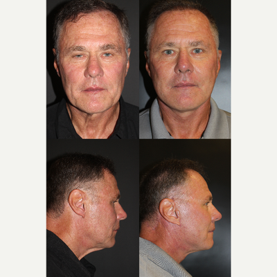 Facelift before and after photo