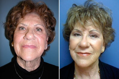 Facelift before and after photo