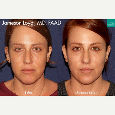 Botox before and after photo