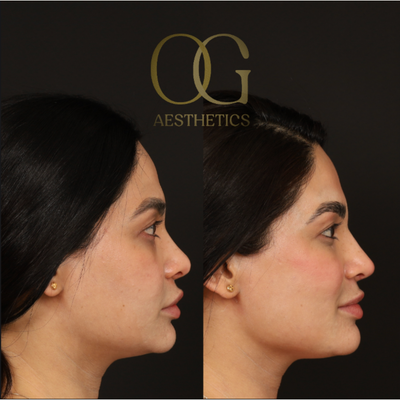 Asian Rhinoplasty before and after photo
