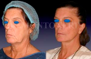 Facelift before and after photo