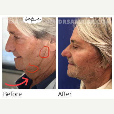 Neck Lift before and after photo