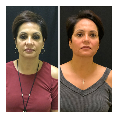 NovaThreads before and after photo